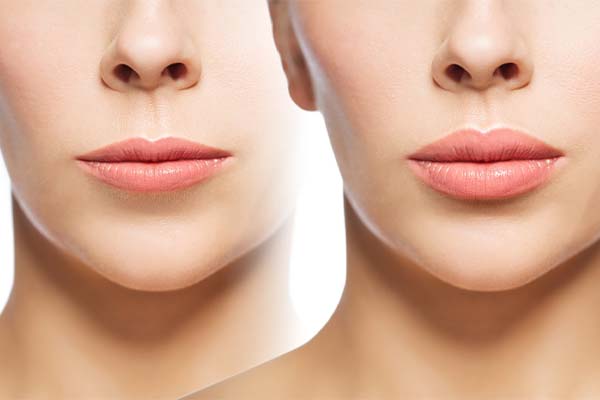 lip lift avant apres lifting levre superieure avant apres docteur frederic picard chirurgien esthetique paris levallois-perret