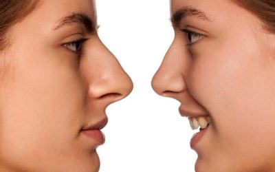 Rhinoplastie ultrasonique : comment se déroule la chirurgie du nez par ultrason ?