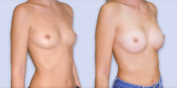 augmentation mammaire prix france chirurgie plastique chirurgien esthetique paris docteur frederic picard paris 16 augmentation mammaire prix france chirurgie plastique chirurgien esthetique paris docteur frederic picard paris 16