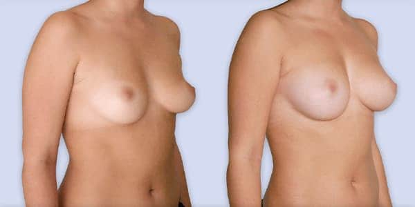 augmentation mammaire prix france chirurgie plastique chirurgien esthetique paris docteur frederic picard paris 16 augmentation mammaire prix france chirurgie plastique chirurgien esthetique paris docteur frederic picard paris 16