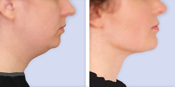 augmentation mammaire prix france chirurgie plastique chirurgien esthetique paris docteur frederic picard paris 16 augmentation mammaire prix france chirurgie plastique chirurgien esthetique paris docteur frederic picard paris 16