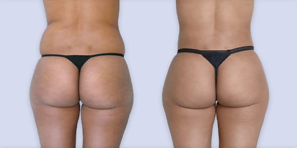 augmentation mammaire prix france chirurgie plastique chirurgien esthetique paris docteur frederic picard paris 16 augmentation mammaire prix france chirurgie plastique chirurgien esthetique paris docteur frederic picard paris 16