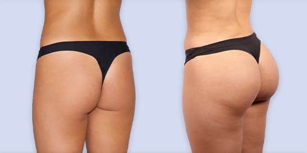 augmentation mammaire prix france chirurgie plastique chirurgien esthetique paris docteur frederic picard paris 16 augmentation mammaire prix france chirurgie plastique chirurgien esthetique paris docteur frederic picard paris 16