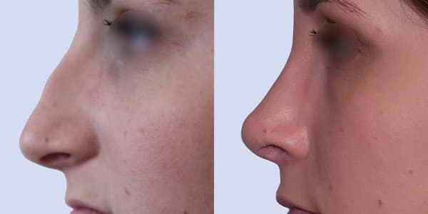 augmentation mammaire prix france chirurgie plastique chirurgien esthetique paris docteur frederic picard paris 16 augmentation mammaire prix france chirurgie plastique chirurgien esthetique paris docteur frederic picard paris 16