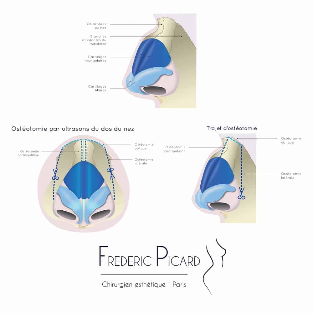 blepharoplastie supérieure paris france chirurgie plastique chirurgien esthetique paris docteur frederic picard paris 16