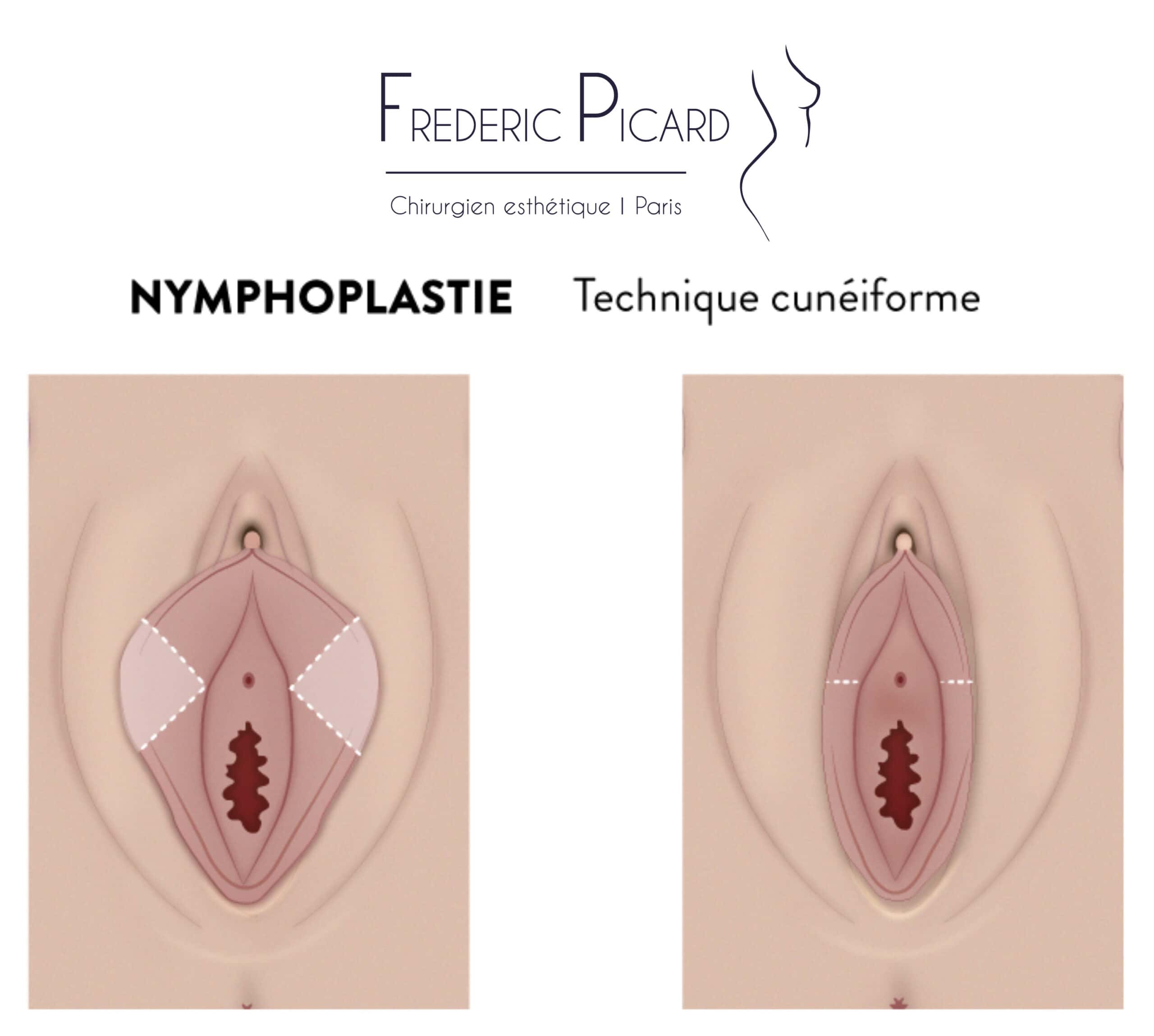 blepharoplastie supérieure paris france chirurgie plastique chirurgien esthetique paris docteur frederic picard paris 16