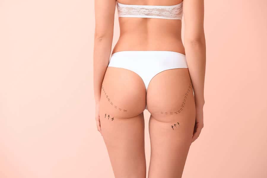 augmentation volume fessier bbl dr frederic picard chirurgien esthetique chirurgie fessiers paris