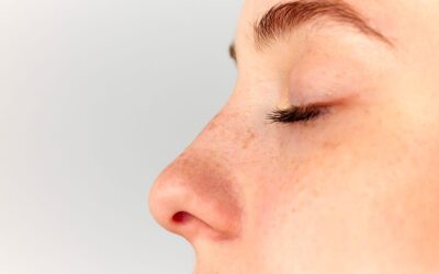 Rhinoplastie : comment se passe la convalescence après une opération du nez ?