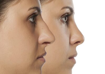 Dans quels cas une rhinoplastie est prise en charge ?
