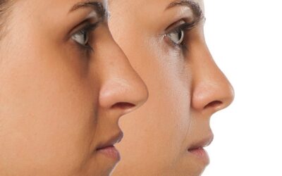 Rhinoplastie ultrasonique et cicatrices : à quoi peut-on s’attendre ?