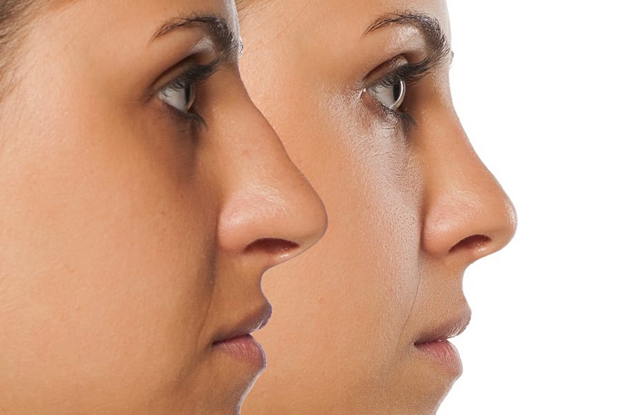 rhinoplastie ultrasonique cicatrice dr frederic picard chirurgien esthetique chirurgie visage paris