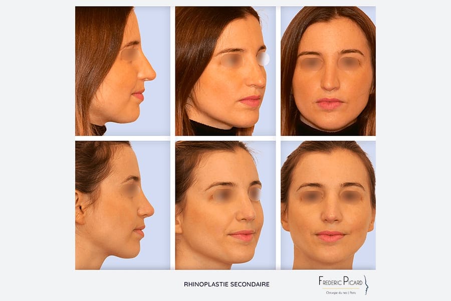 avant apres deuxieme rhinoplastie secondaire chirurgie du nez operation esthetique du nez rhinoplastie resultat chirurgie plastique chirurgien esthetique paris docteur frederic picard 1