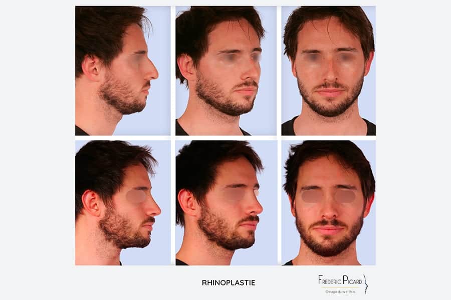 avant apres rhinoplastie pour homme chirurgie du nez operation esthetique du nez rhinoplastie resultat chirurgie plastique chirurgien esthetique paris docteur frederic picard 4