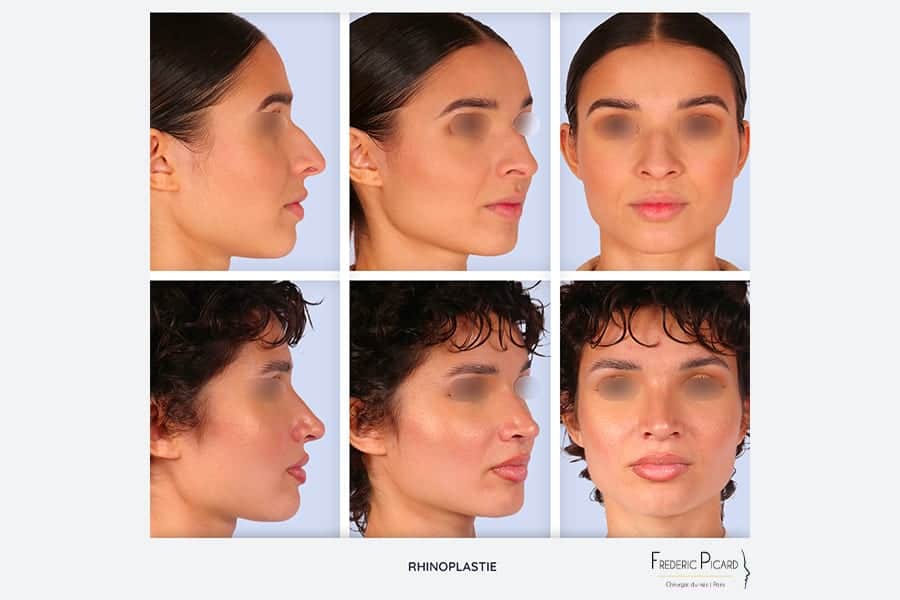 avant apres rhinoplastie ultrasonique rhinoplastie par ultrasons chirurgie du nez operation esthetique du nez rhinoplastie resultat chirurgien esthetique paris dr frederic picard 11