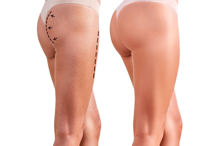 comment avoir un bbl naturel lipofilling fesse chirurgie des fesses dr frederic picard chirurgien esthetique paris chirurgie comment avoir un bbl naturel lipofilling fesse chirurgie des fesses dr frederic picard chirurgien esthetique paris chirurgie